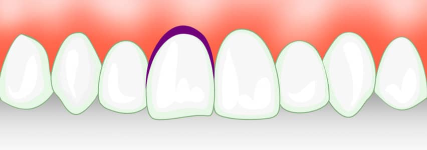 Zahntrauma / Zahnunfall: Schneidezahn ausgeschlagen, Zahn locker oder Riss ...
