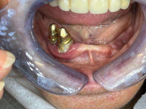 Patientenfall: Stegkonstruktion - Zahnsituation