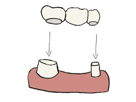 Zahn Brücke im Vergleich zum Implantat