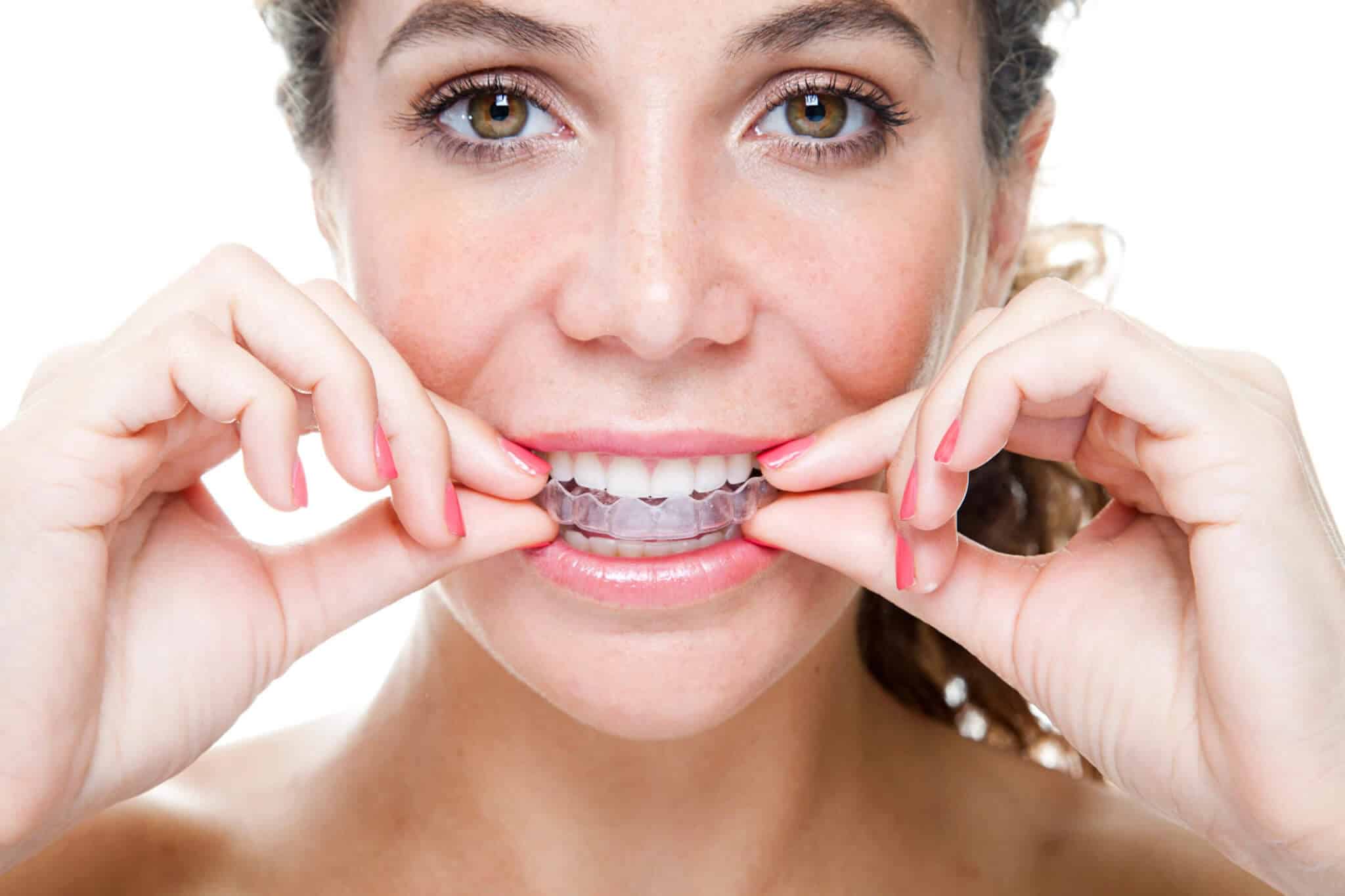 Frau beim Einsetzen einer Zahnschiene zur Korrektur der Zahnästhetik