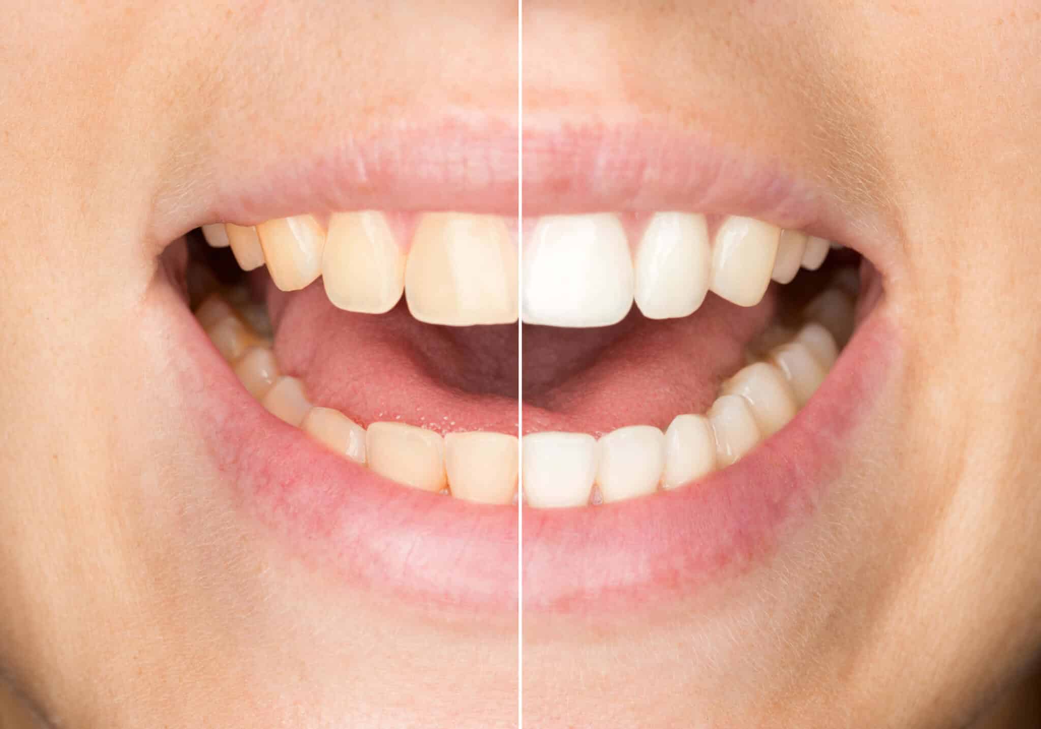 Geöffneter Mund mit Vorher-Nachher-Vergleich nach einer Zahnaufhellung
