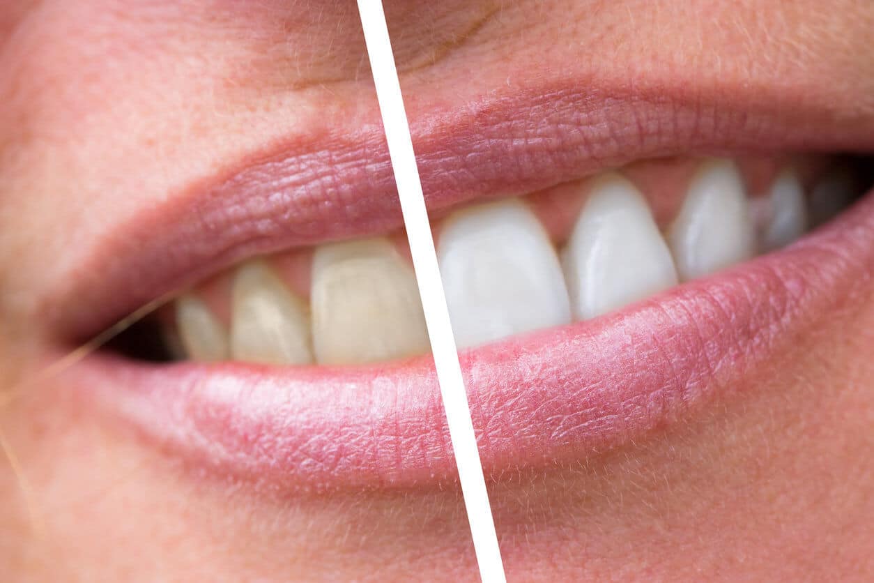 Vorher-Nachher-Vergleich eines Zahnbleachings