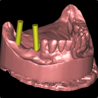Zahnimplantate: Planung, Ablauf & Behandlung