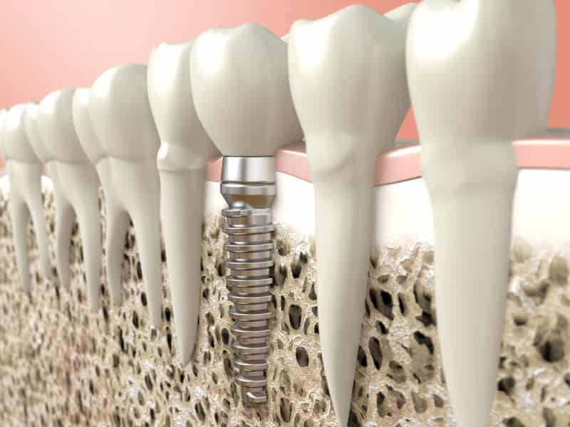 Zahnimplantat im Kiefer neben natürlichen Zähnen