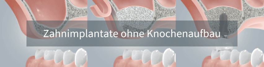 Zahnimplantate ohne vorigen Knochenaufbau setzen