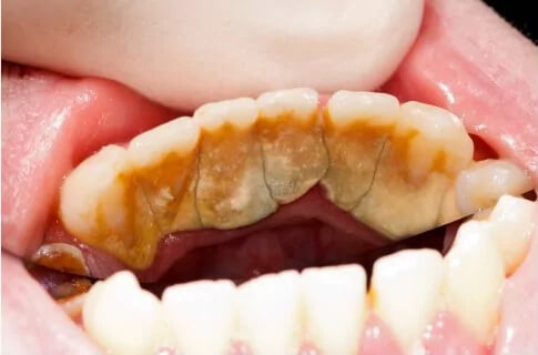 Verhärteter Geblicher Zahnbelag / Zahnstein an Schneidezähnen und Eckzähnen
