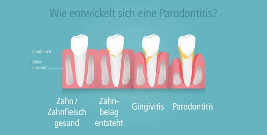 Wie entwickelt sich eine Parodontitis? Ablauf in vier Stufen: Gesundes Zahnfleisch, Zahnbelag, Gingivitis, Parodontitis