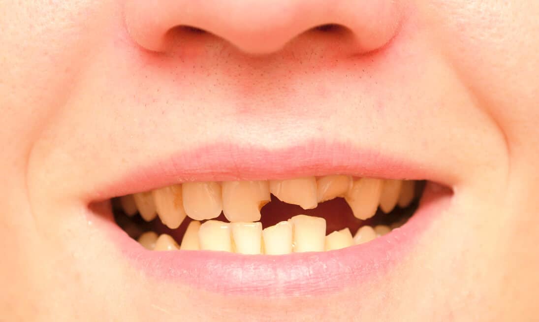 Abgebrochen zahn halb ω Zahn